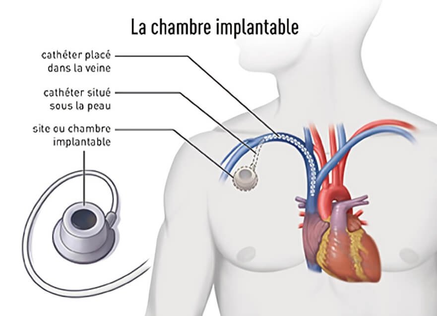 Pose de Chambre Implantable à Tanger - Dr. Taous Hamza